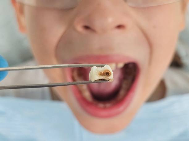 Best Emergency Wisdom Teeth Removal in Benton, AR